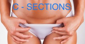 Back Neck Or Groin Pain It Could Be Your C Section Fitnash